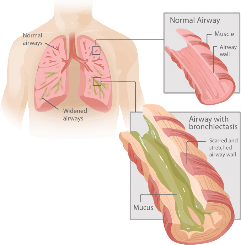 Bronchiectasis Lung Care Foundation